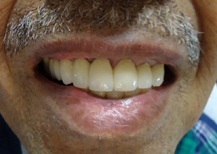 Full Mouth Rehabilitation cost in Vadodara
